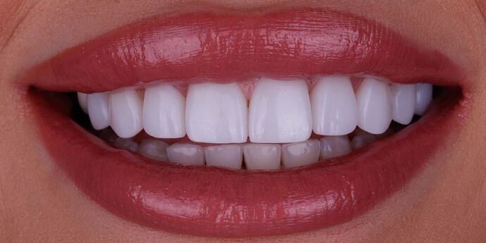 after veneers