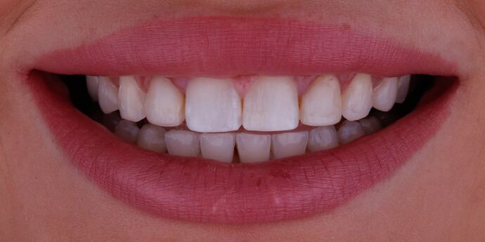 before veneers